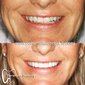 We are the best dentistry for composite veneers in Parramatta.