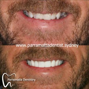 We provide the best dental veneers in Parramatta.
