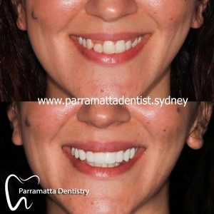 We are the experts of cosmetic dentistry in Parramatta.