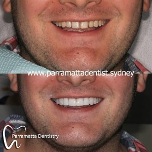We are the experts of dental veneers in Parramatta.