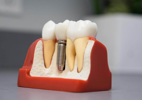 Dental Implant Cost Parramatta