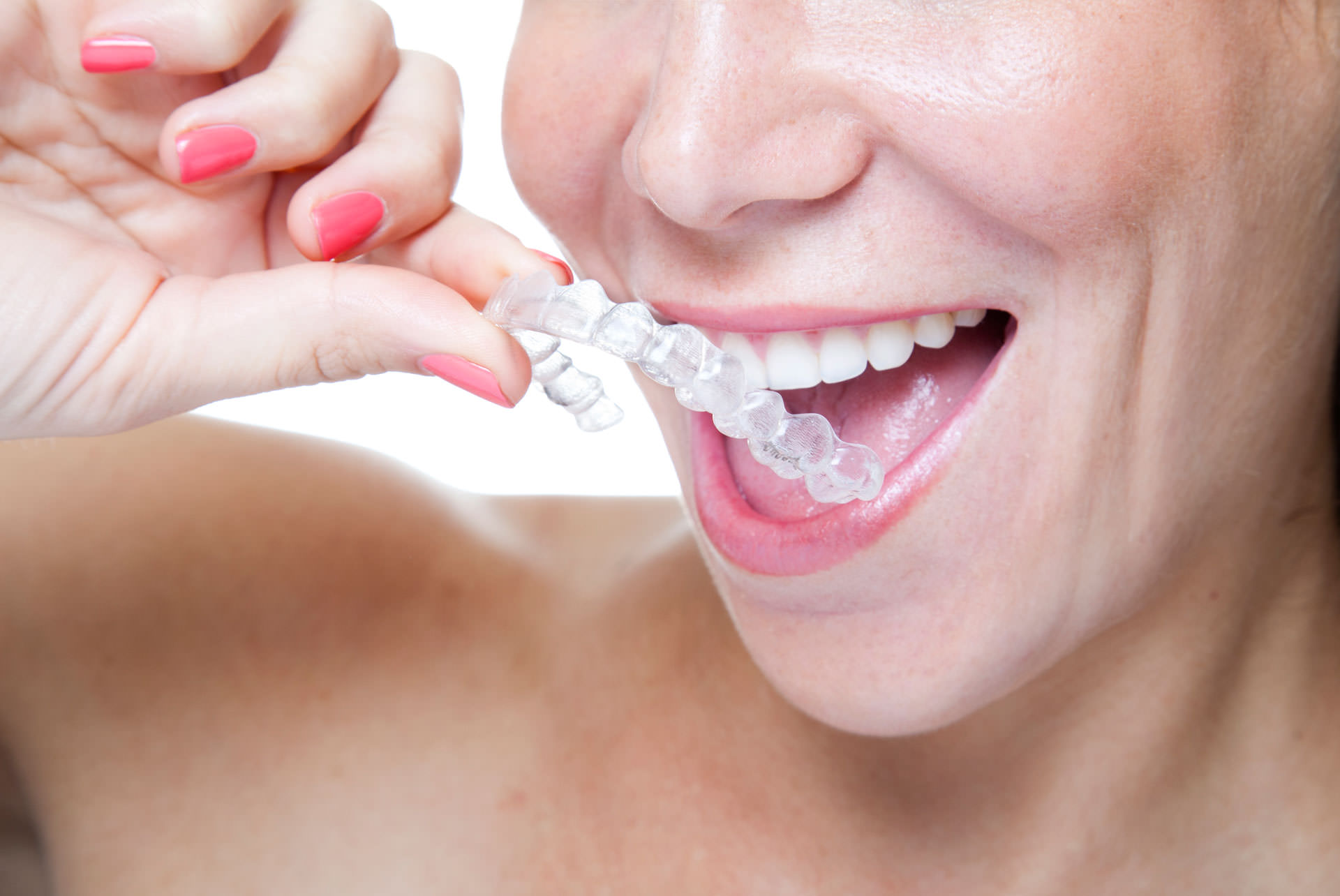 We are the best Invisalign provider in Parramatta.