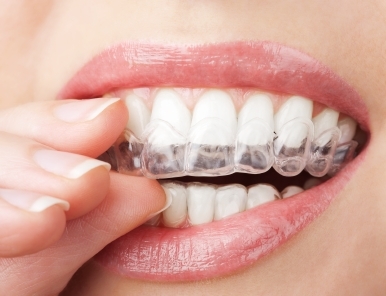 We are the best Invisalign provider in Parramatta.