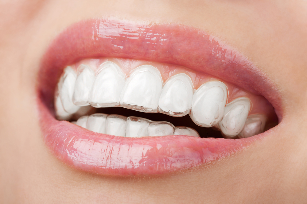 We are the best dentistry for Invisalign in Parramatta.