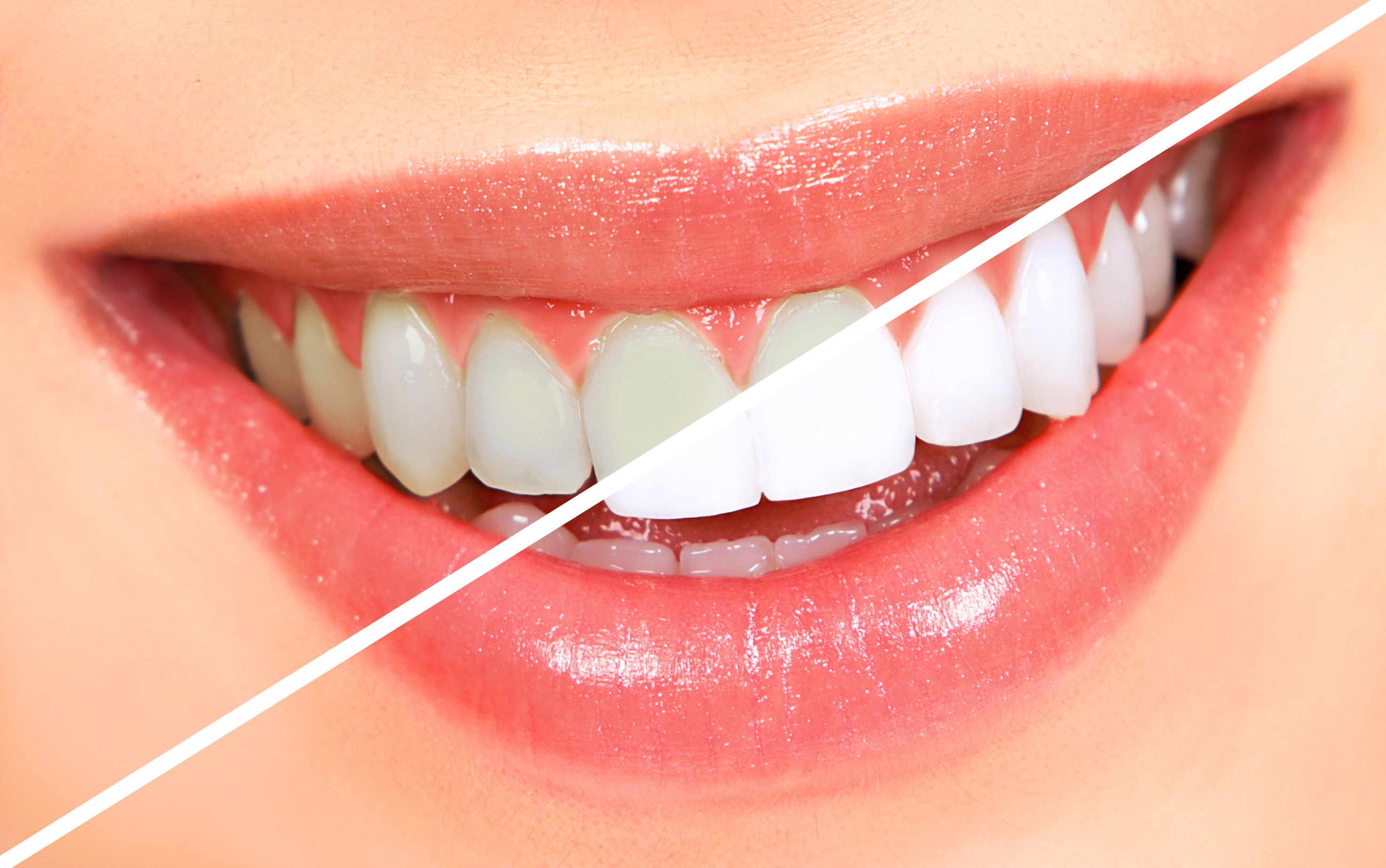 We are the best teeth whitening dentistry in Parramatta.