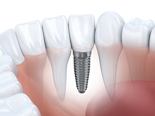 We are the best in dental implants here in Parramatta.