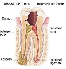 We are the best dentistry for root canal therapy in Parramatta.