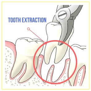 Tooth Removal is done by our expert dentist in Parramatta