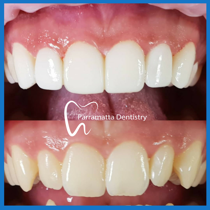 Porcelain veneers in Parramatta