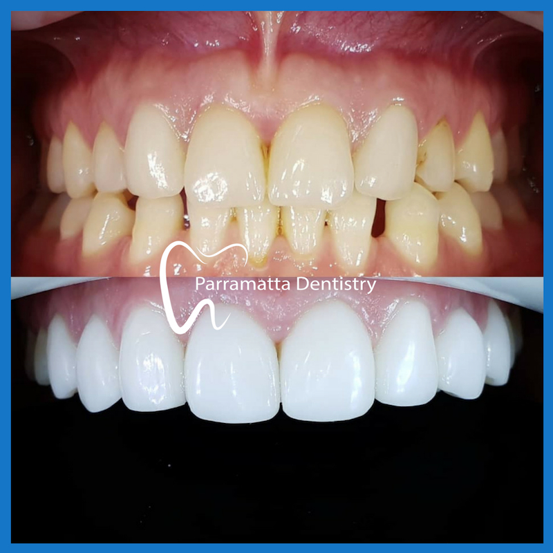 Porcelain veneers in Parramatta