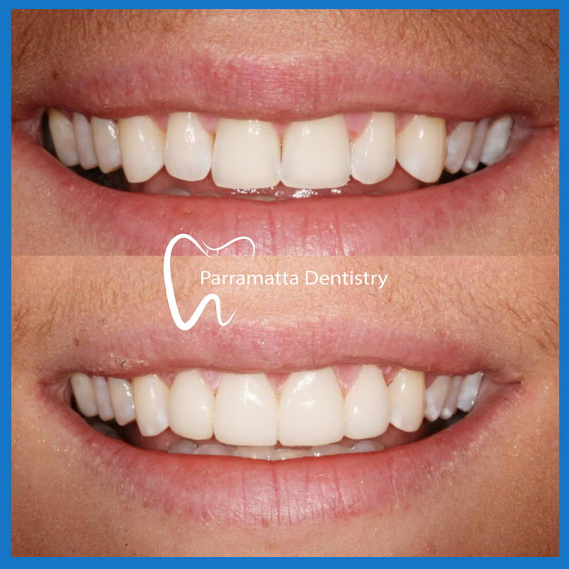 Veneers in Parramatta