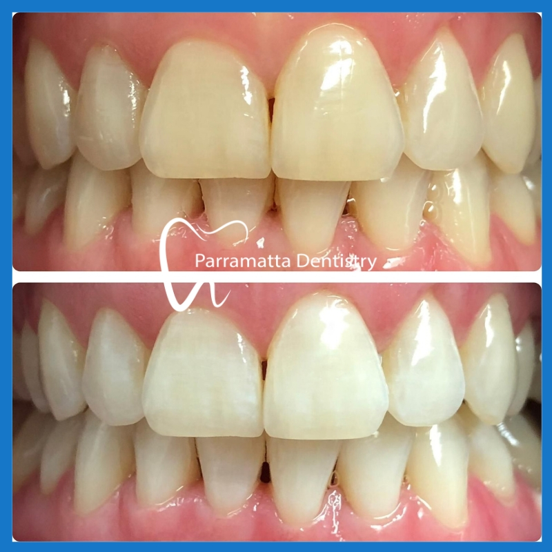 Teeth Whitening in Parramatta