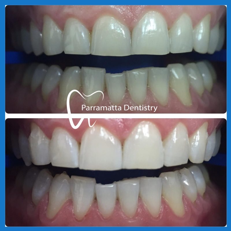 Best dentist for teeth whitening in Parramatta
