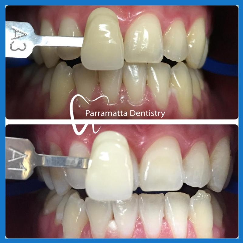 Affordable teeth whitening in Parramatta