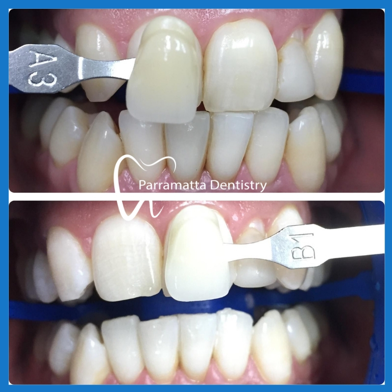 Teeth whitening in Parramatta