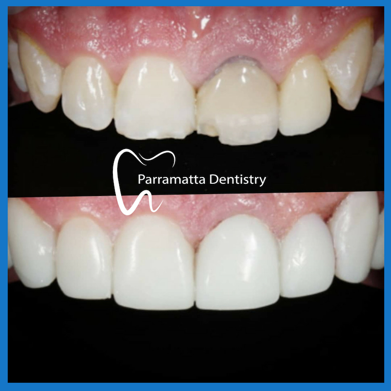 Best veneers in Parramatta