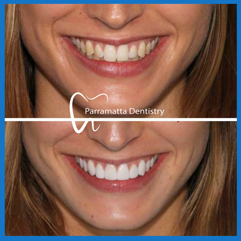 Veneers in Parramatta