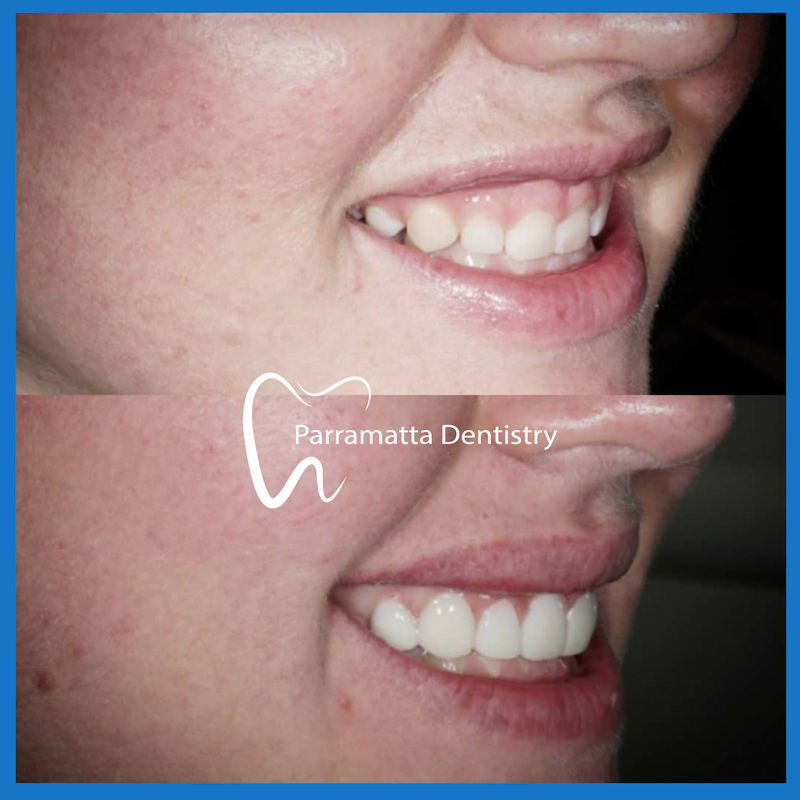 Best dentist for veneers in Parramatta