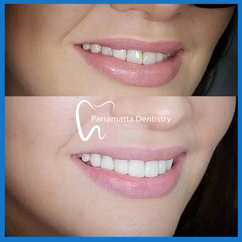 Affordable dental veneers in Parramatta