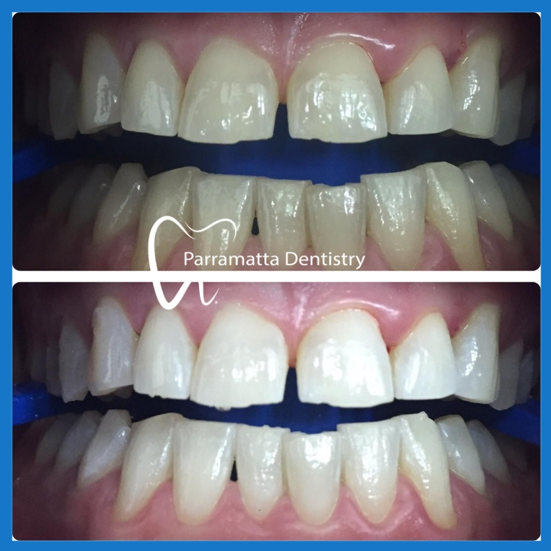 Best teeth whitening in Parramatta