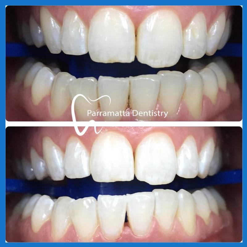 Affordable teeth whitening in Parramatta