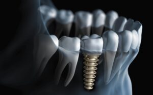 dental implants near me