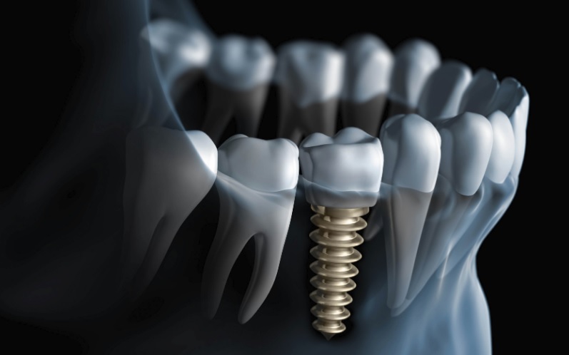 dental implants near me