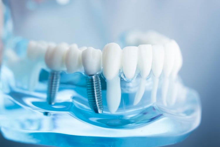 We have the best dentist for dental implant in Parramatta.