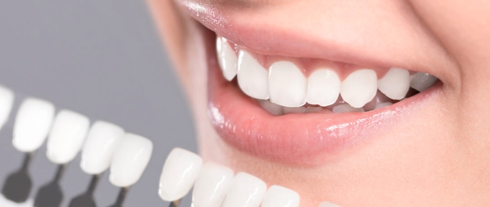 Composite Veneers vs Porcelain Veneers | We have the best dental veneers in Parramatta.