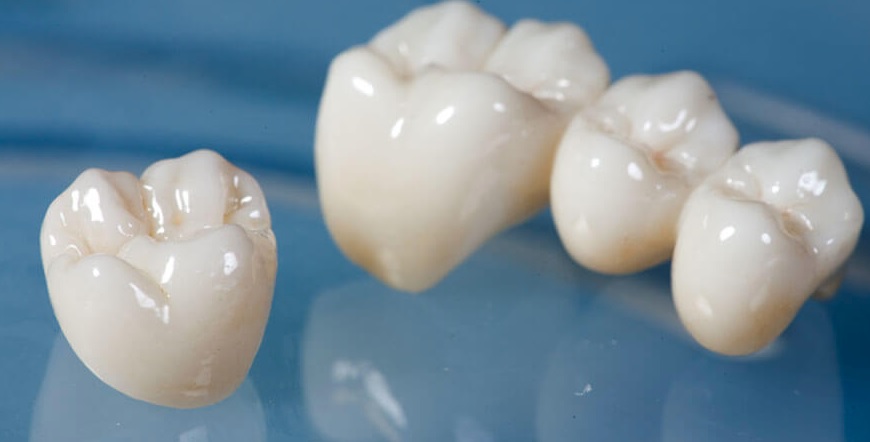 We have the best dental crowns in Parramatta.