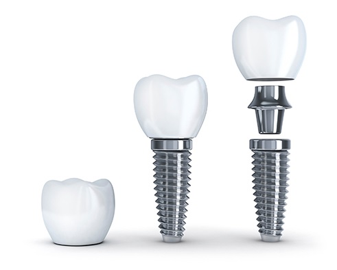 We have the best dental implant in Parramatta.