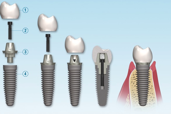 Dental Bridge vs Implant | We have the best dentist for dental implant in Parramatta.