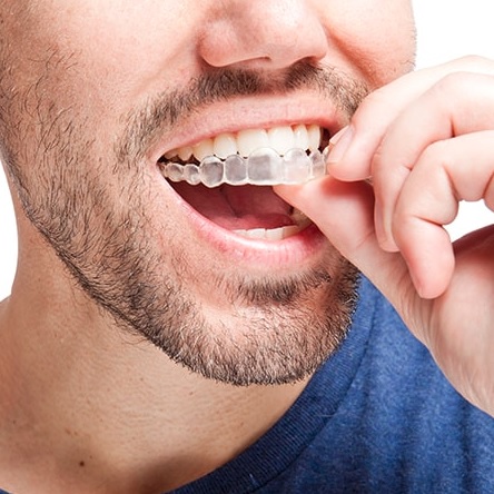 We offer affordable Invisalign here in Parramatta.