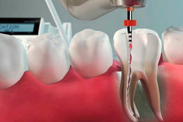 We provide quality root canal therapy in Parramatta.