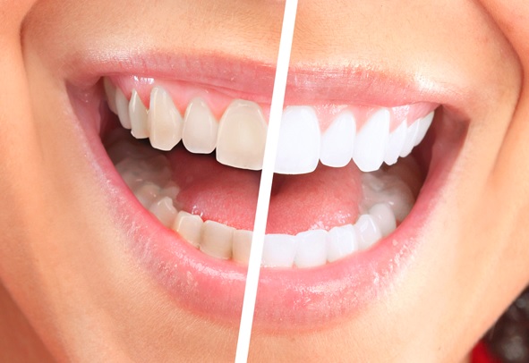 We have affordable teeth whitening in Parramatta.