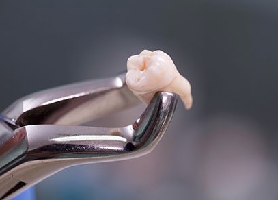 We are the best in wisdom tooth removal here in Parramatta.