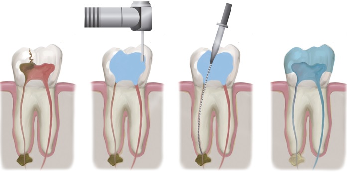 We provide quality root canal therapy in Parramatta.