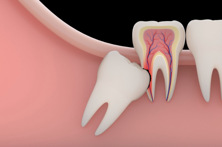 We are the best in wisdom tooth removal here in Parramatta.