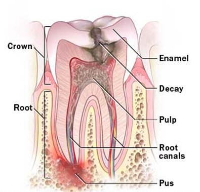 Root canal procedure in Parramatta