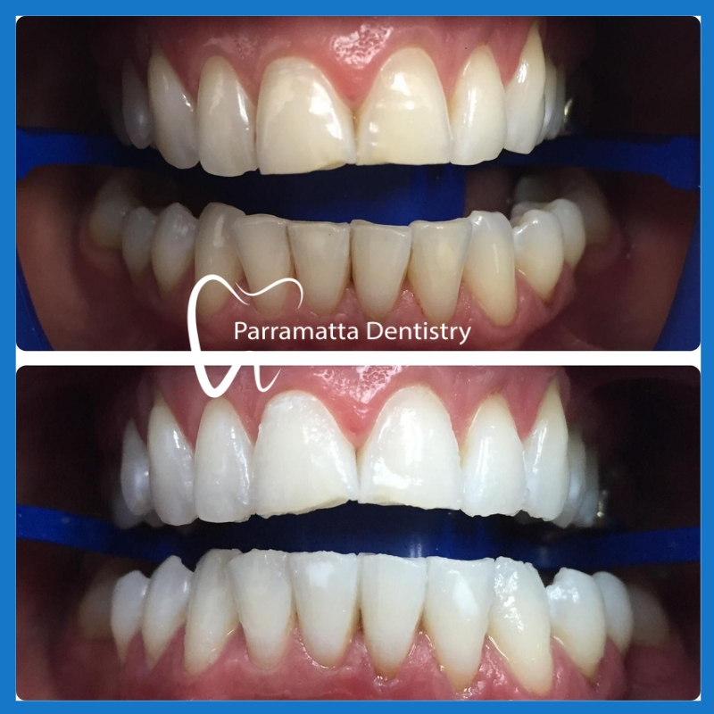 Teeth whitening procedure in Parramatta