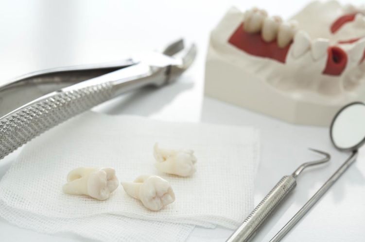 Tooth extraction aftercare in Parramatta