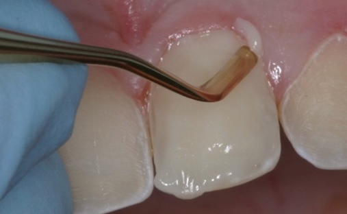 Composite veneers in Parramatta