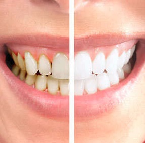 laser teeth whitening Parramatta