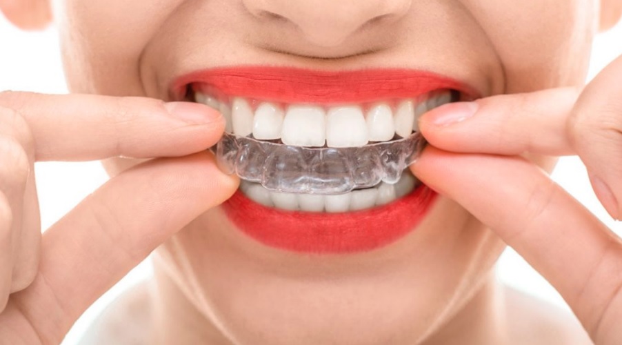 Invisalign Cost in Parramatta