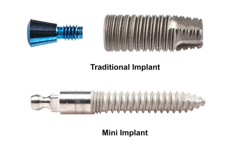 Implant in Parramatta