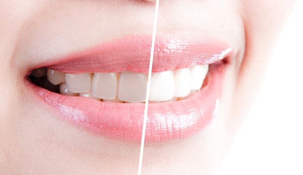 Pros and cons of teeth whitening in Parramatta