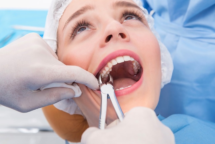 Tooth removal in Parramatta