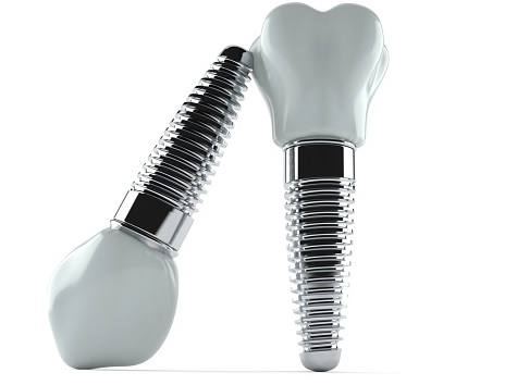 Dental Implant Cost in Parramatta