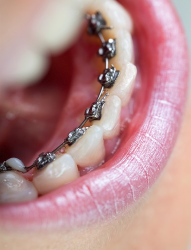 Orthodontics in Parramatta