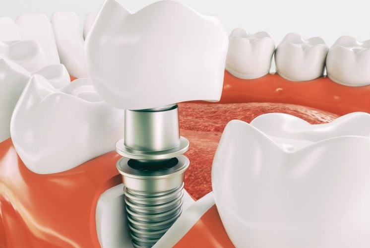 tooth implant in Parramatta recovery time
